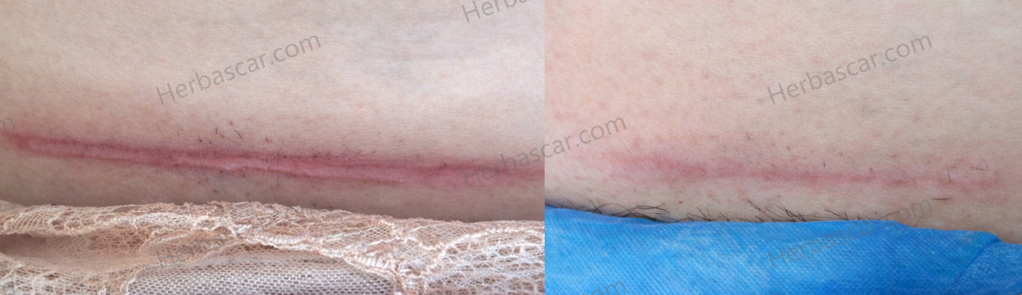 Effective Treatment for a Stubborn C-Section Scar in 3 Months