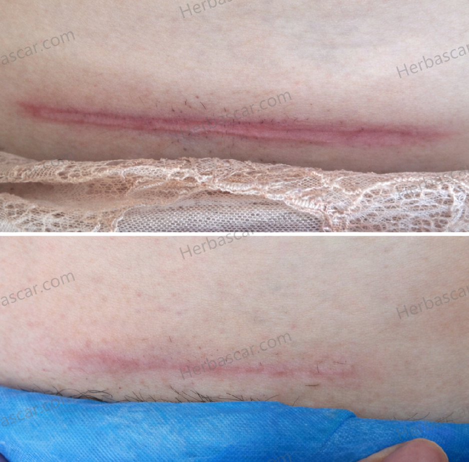 Real Before-and-After Photos of a Stubborn C-Section Scar