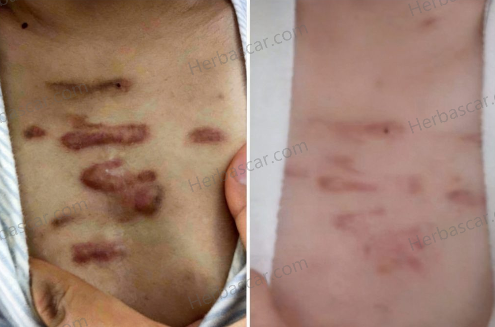 Chest Keloid Improvement: Before vs. After Treatment