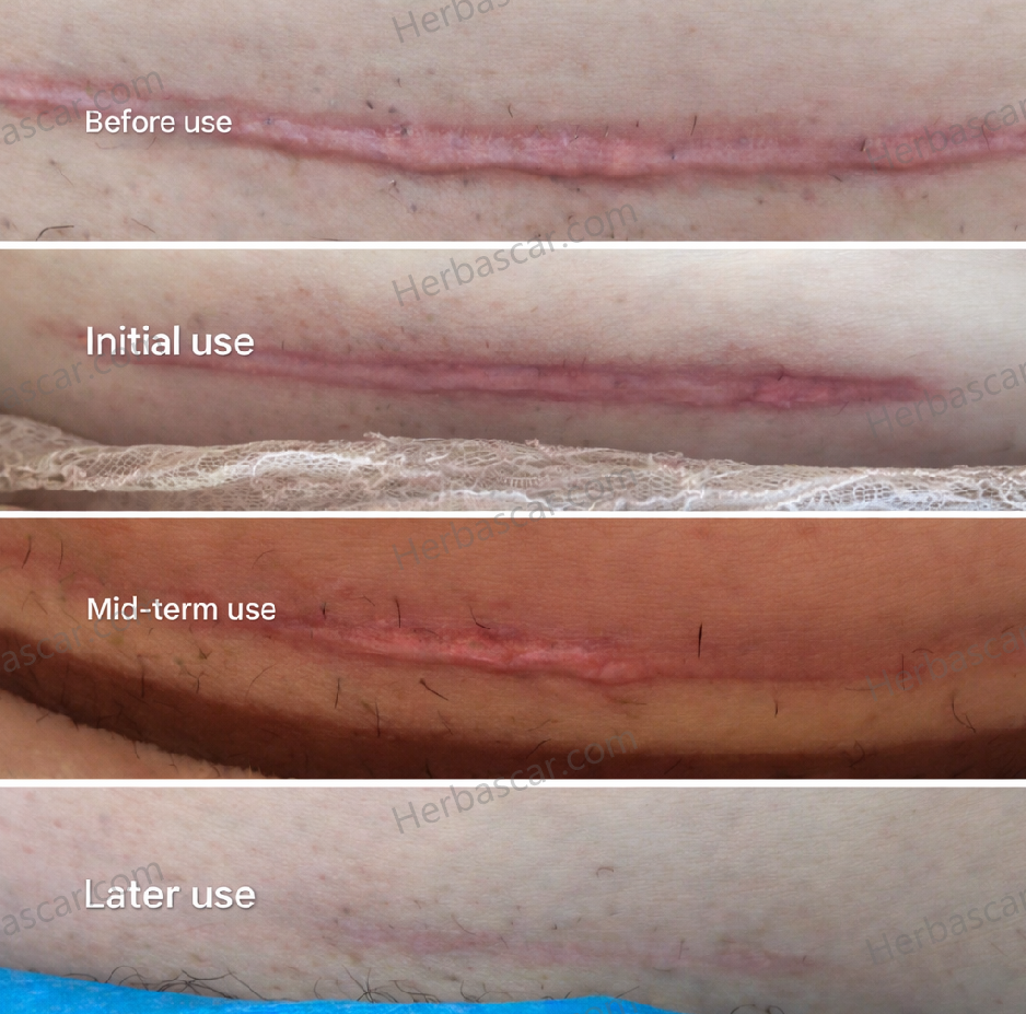 Before and After Comparison of a Stubborn C-Section Scar