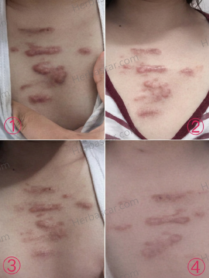 Visible Changes in Chest Keloid Before and After Treatment
