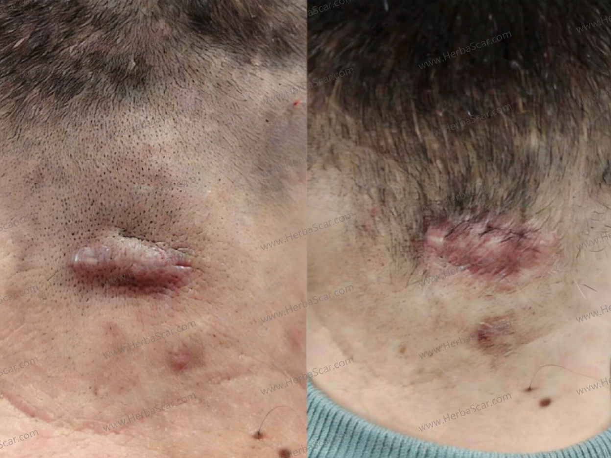 Results Before and After Applying Herba Scar Removal Liquid