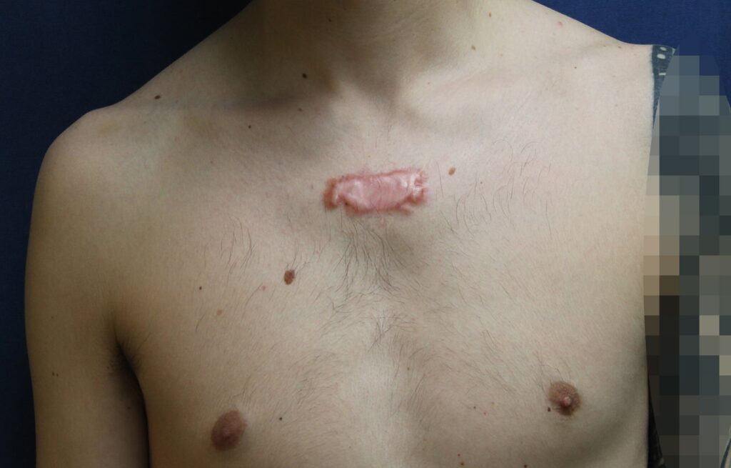 keloid on the chest