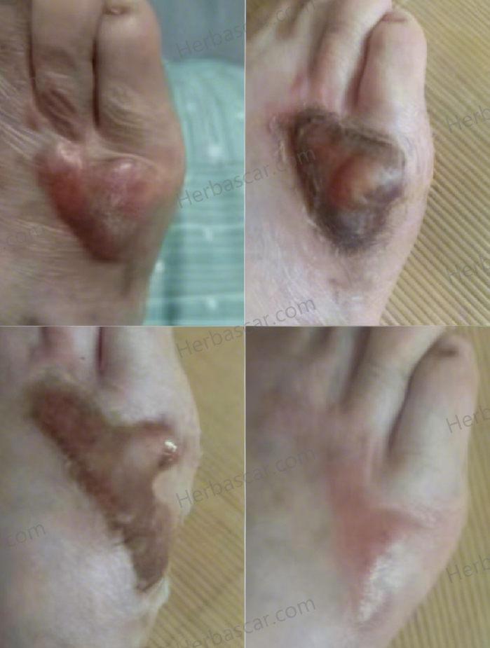 Comparison of a toe hypertrophic scar pre- and post-treatment.