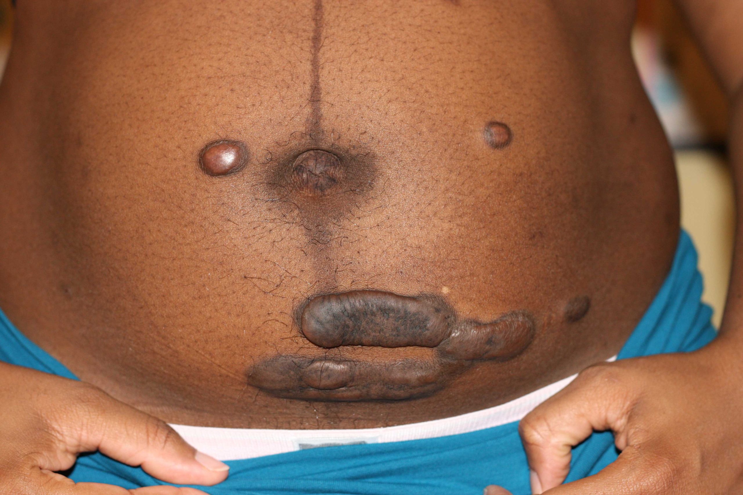 abdominal keloid formation
