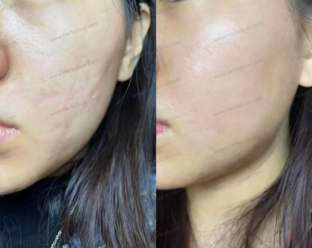 The results are great—the scar has become much flatter.