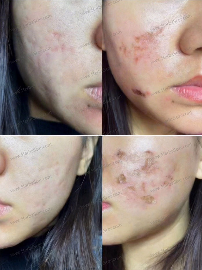 Before and After Photos of Using Herba Scar Removal Liquid