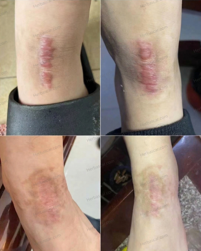 Before-and-after comparison of thigh burn scar treatment.