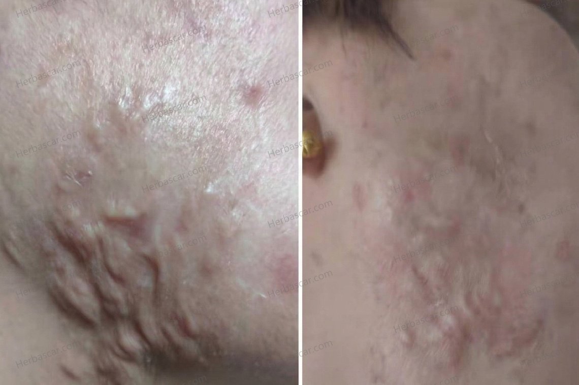 Stubborn Nodular Acne Scars at 48? How Ms. Li Softened and Flattened Her Facial Scars Naturally