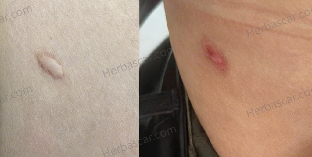 Abdominal Hypertrophic Scar: Before vs After