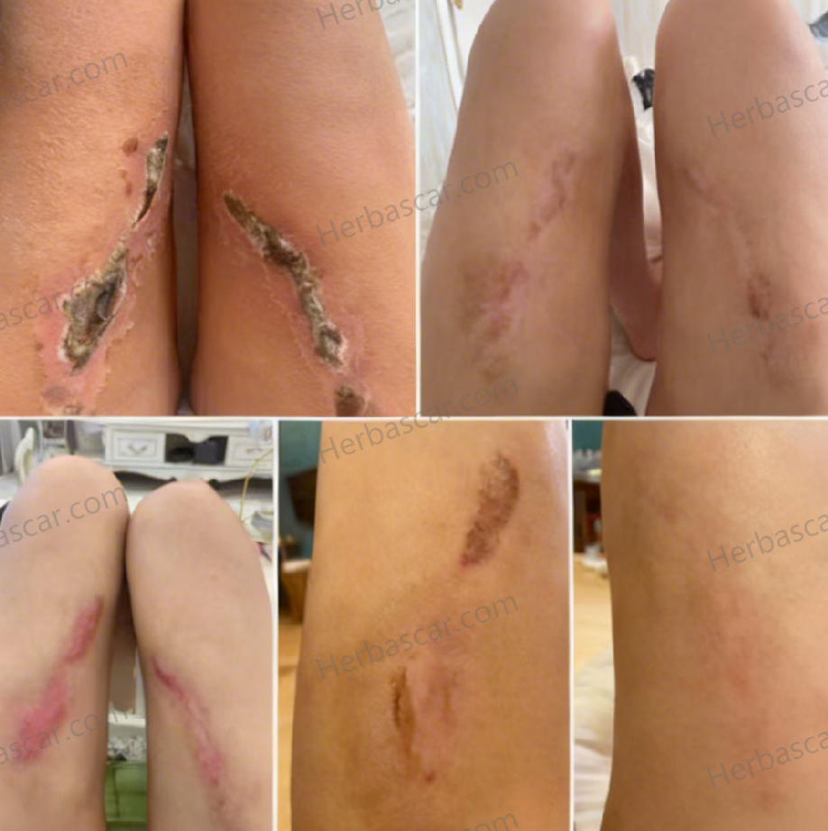 Clinical comparison before and after treatment of a thigh burn scar