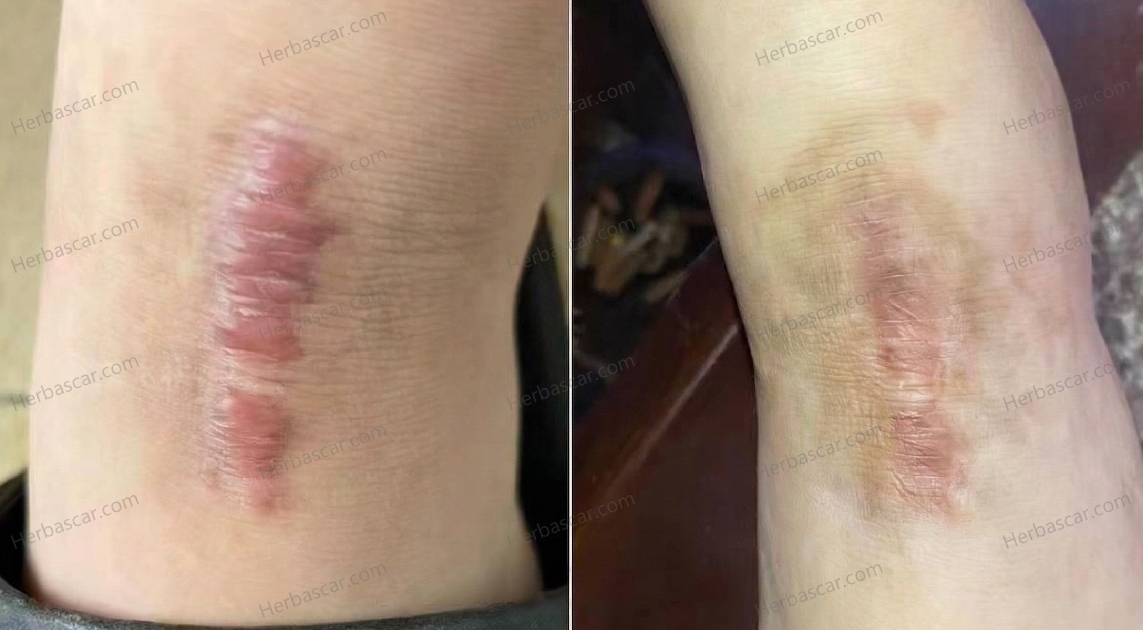 Stubborn Ankle Scar After Surgery? How Lisa Flattened Her Hypertrophic Scar Safely at Home