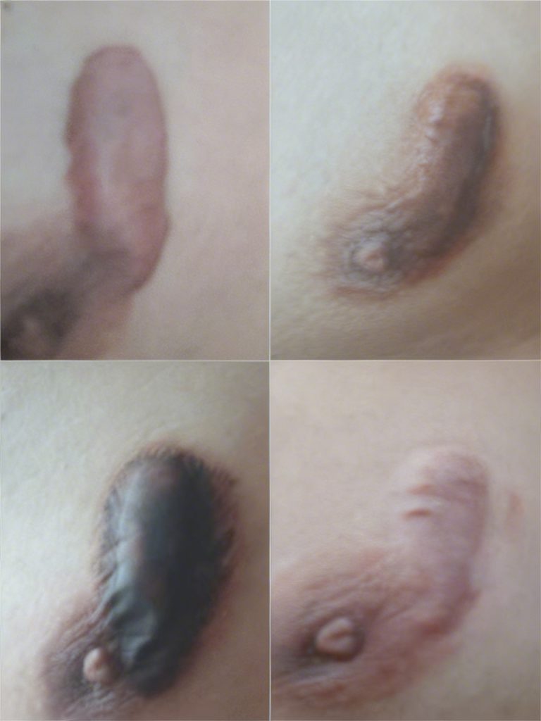 Before-and-after comparison of nipple keloid treatment.