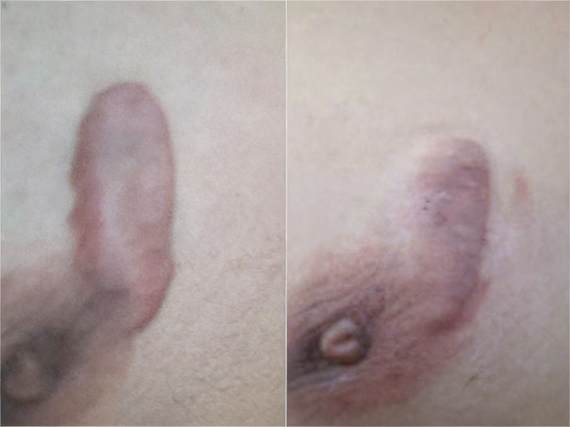Comparison of nipple keloid appearance pre- and post-treatment.