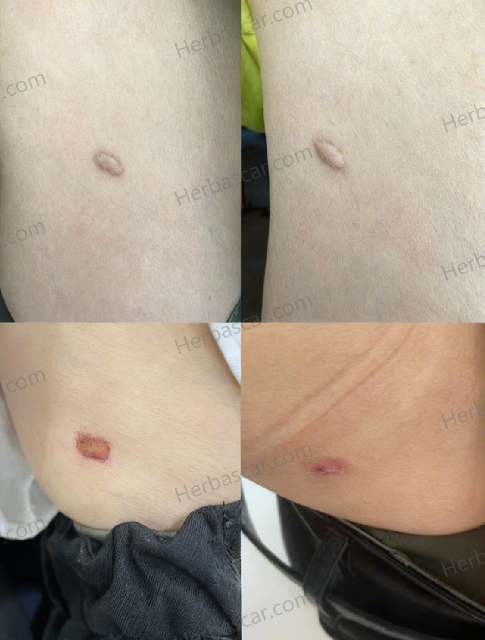 Before and After Treatment of an Abdominal Hypertrophic Scar