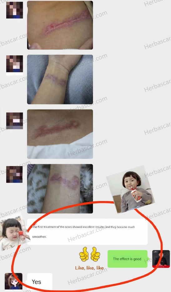 Feedback from patients who applied Herba Scar Removal on tattoo removal scars.
