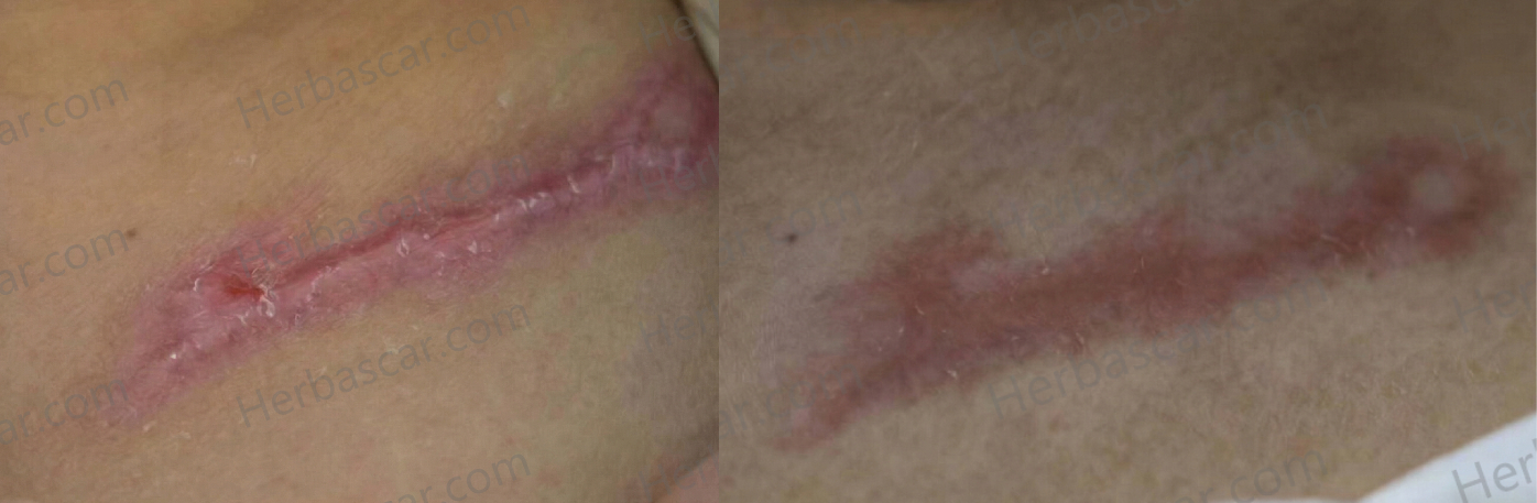 How Emily Naturally Flattened Her Raised Tattoo Keloid Scars