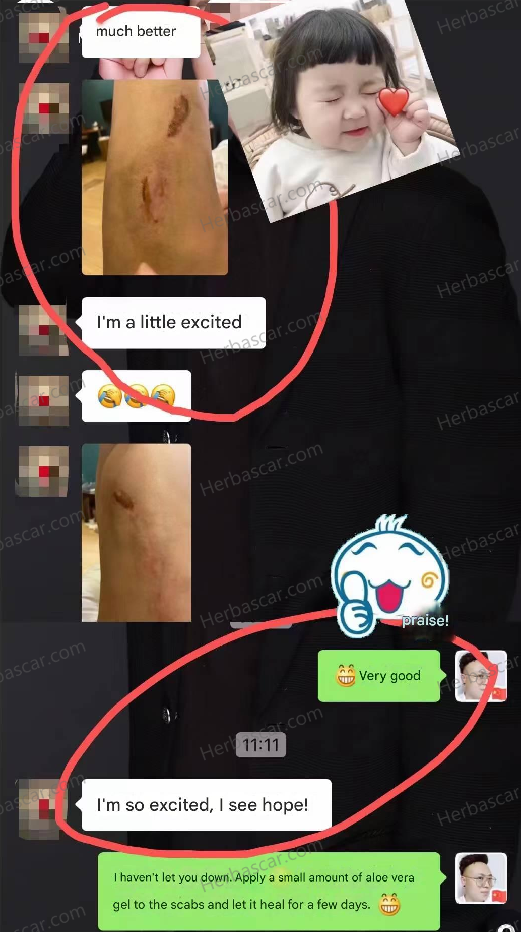 Real results from a patient who used Herba scar serum on a thigh burn keloid after a failed liposuction