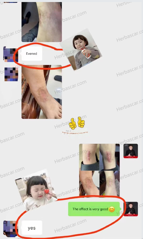 True patient review of Herba scar solution for burn keloids resulting from a botched thigh liposuction.