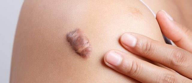 Scar on human skin keloid on shoulder
