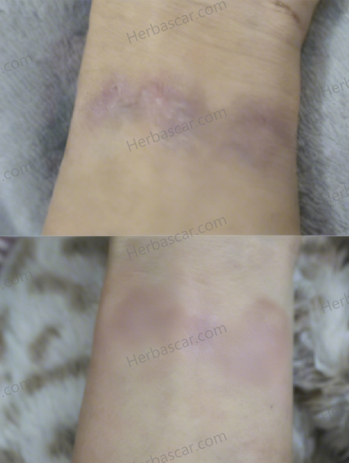 Scar formation on the wrist following tattoo removal.