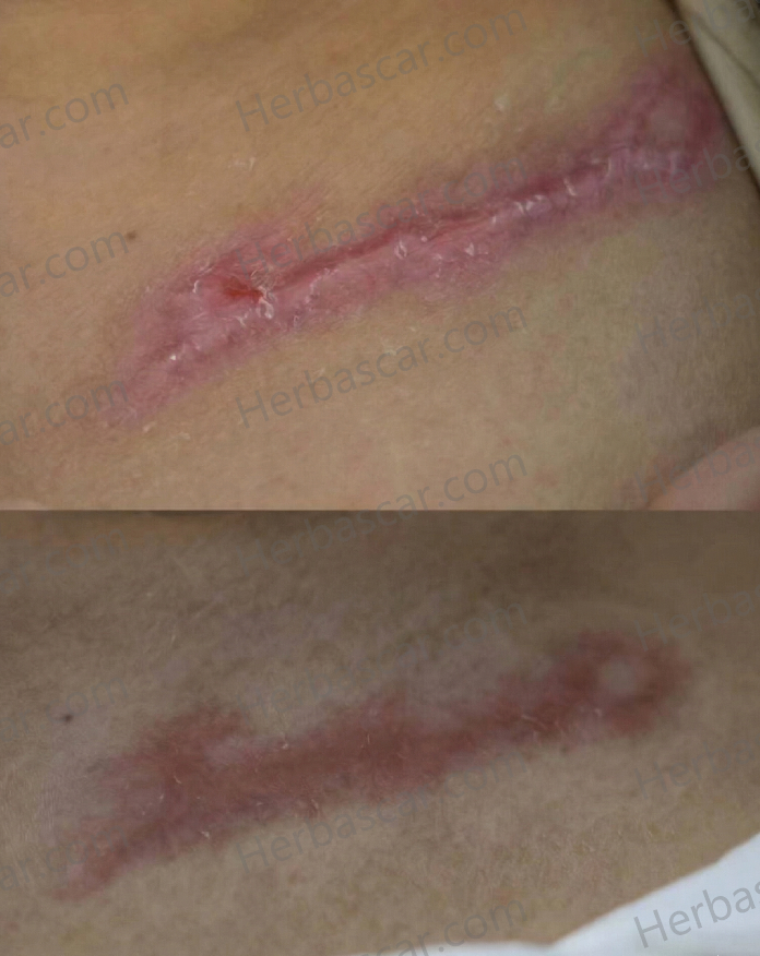 Scarring on the chest under the collarbone after tattoo removal.