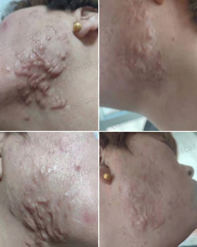 Pre- and post-treatment photos of facial overgrown scars