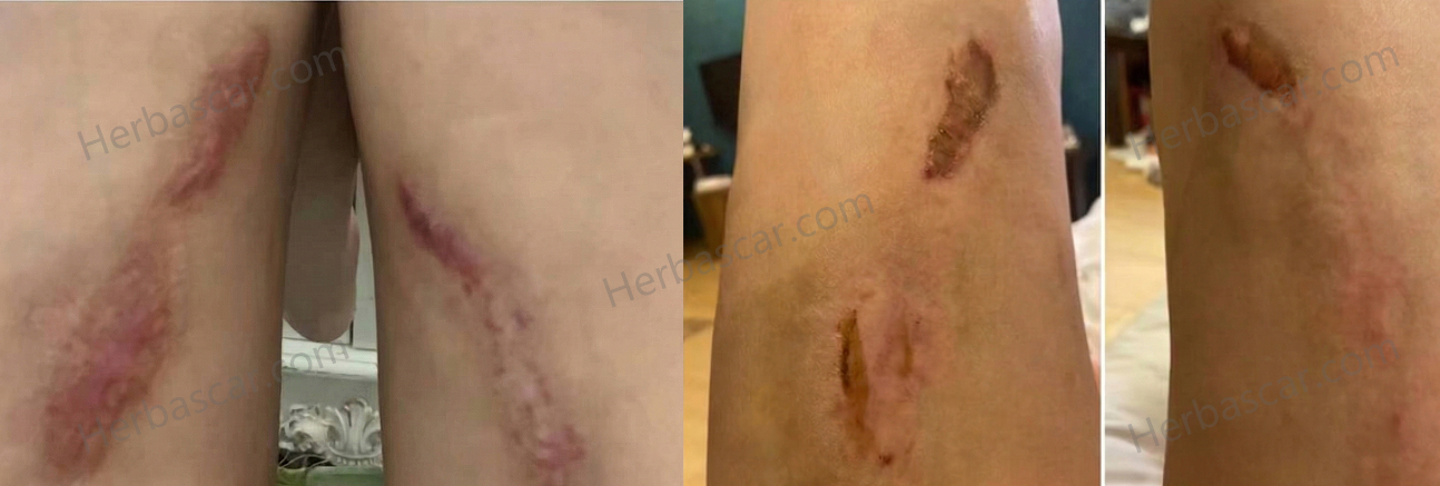 Severe Thigh Scarring After Failed Liposuction: Is Surgery the Only Way Out?