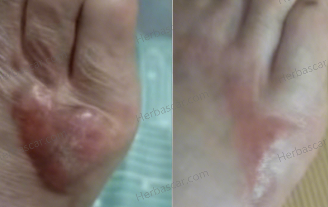 How One Woman Healed a Stubborn Hypertrophic Toe Keloid Scar Naturally