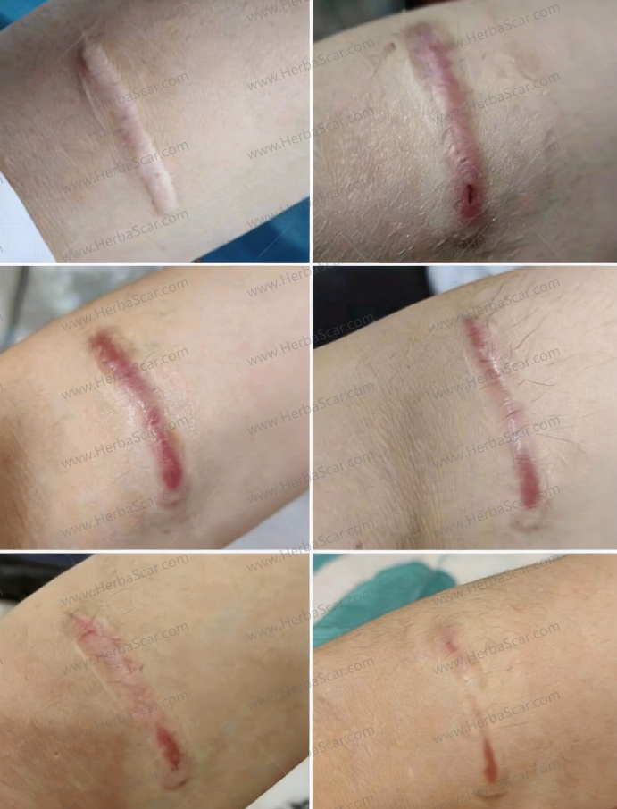 Before-and-After Results with Herba Scar Liquid