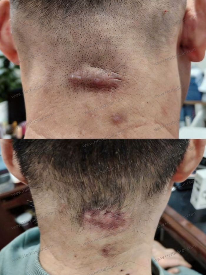 Before and After Photos of Using Herba Scar Removal Liquid