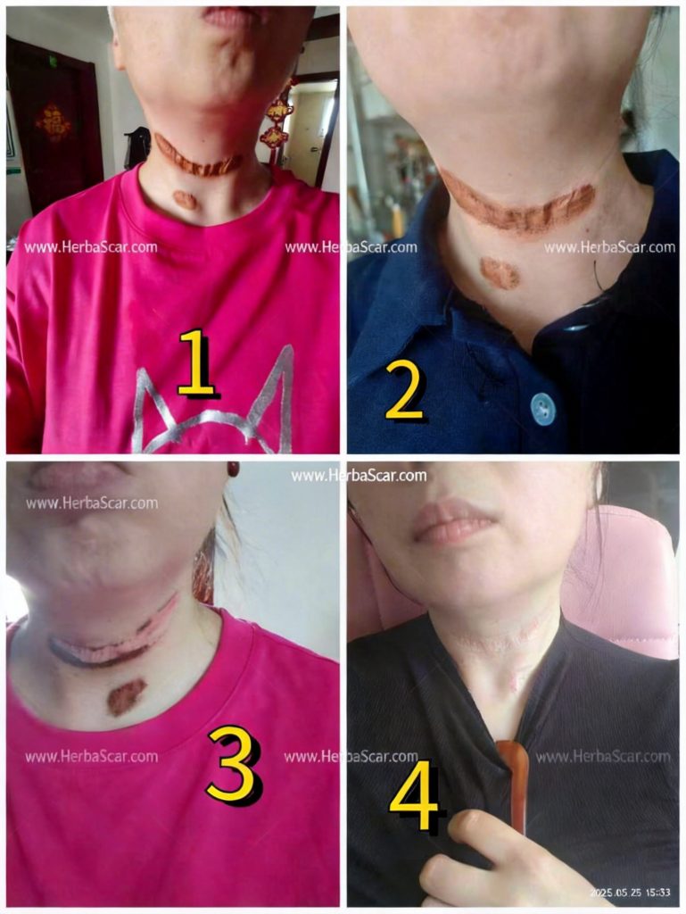 Before & After Photos of Using Herba Scar Removal Liquid