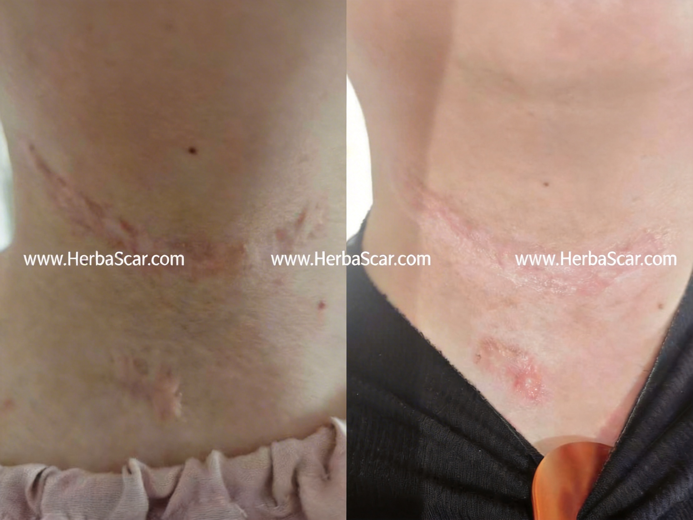 Post-Surgical Hypertrophic Scars Before and After Treatment