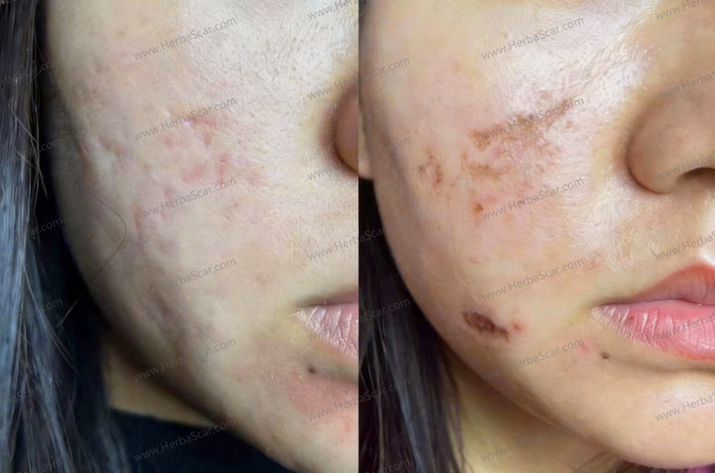 deep-pitted-acne-scars-across-both-cheeks