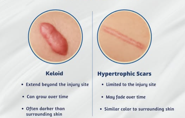 Keloids vs Hypertrophic Scars