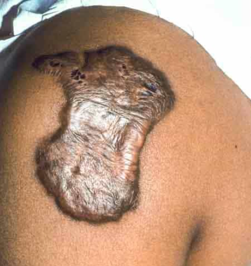 keloid on the shoulder
