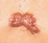 Hypertrophic Scar Images