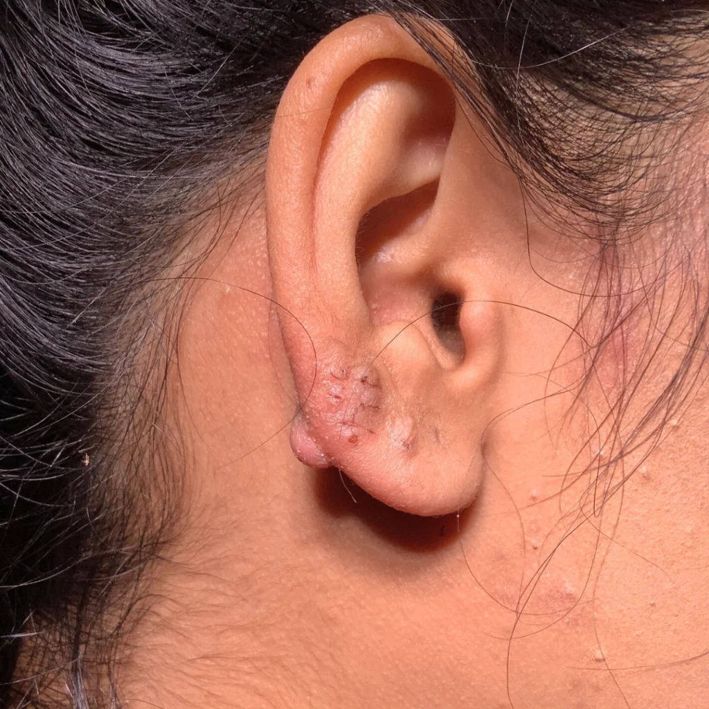 piercing bumps