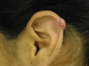 Keloid of the ear
