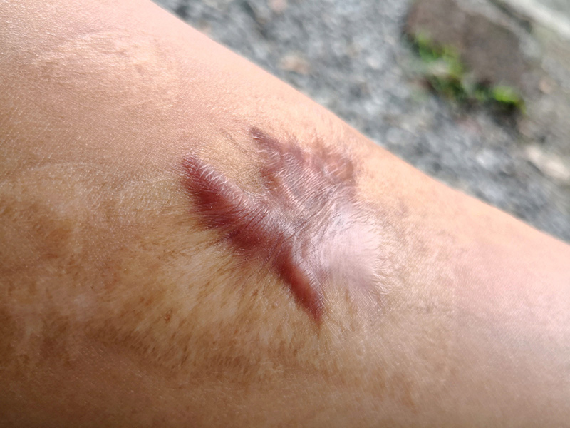 Keloid removal