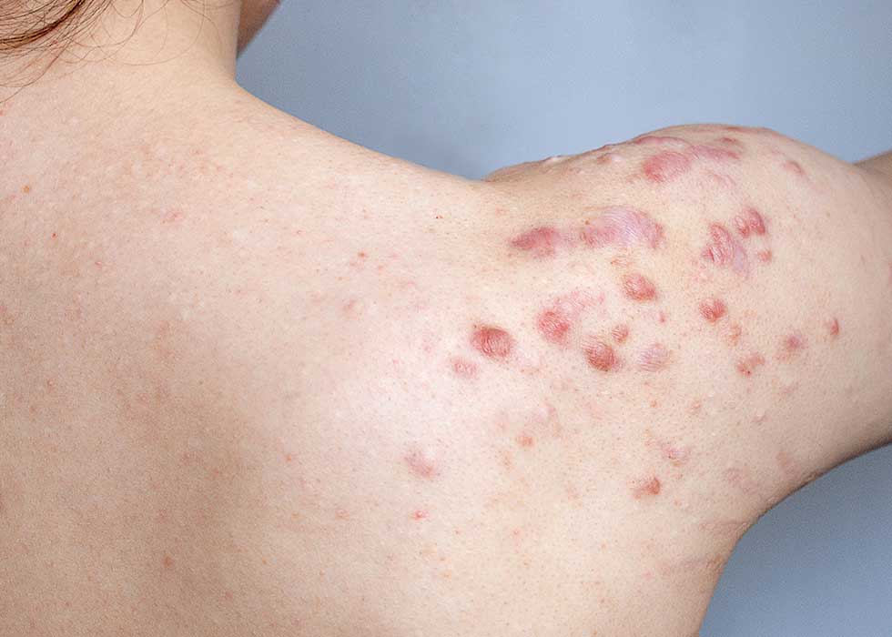 keloids spread across woman's shoulder