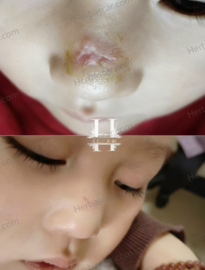 A Stitched Cut on a 3-Year-Old’s Nose… Red, Raised Scar Appearing After Removal