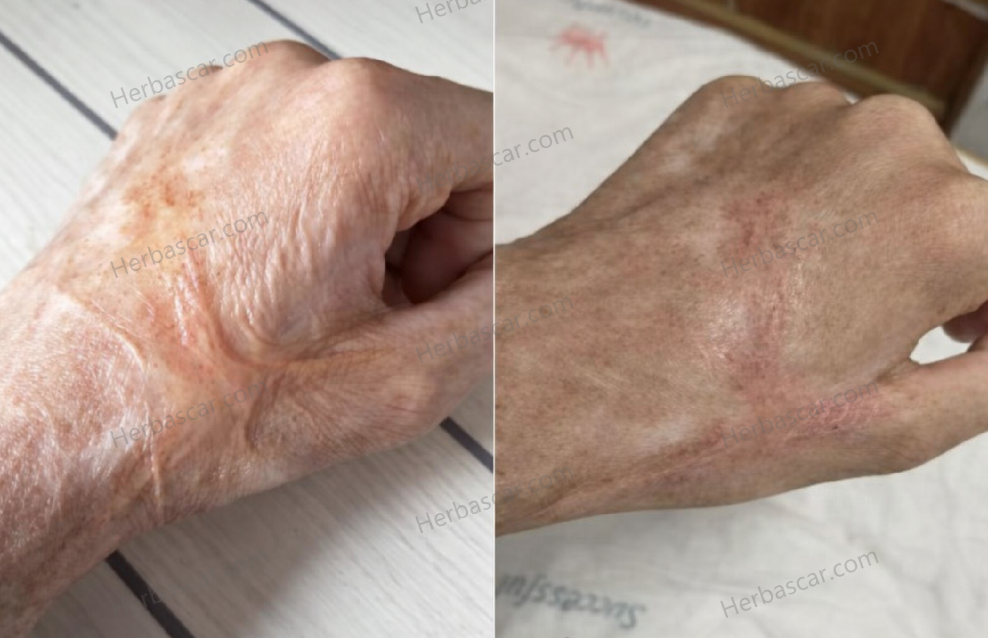 Raised Burn Scar That Wouldn’t Flatten? When Tightness and Visibility Become Daily Stress