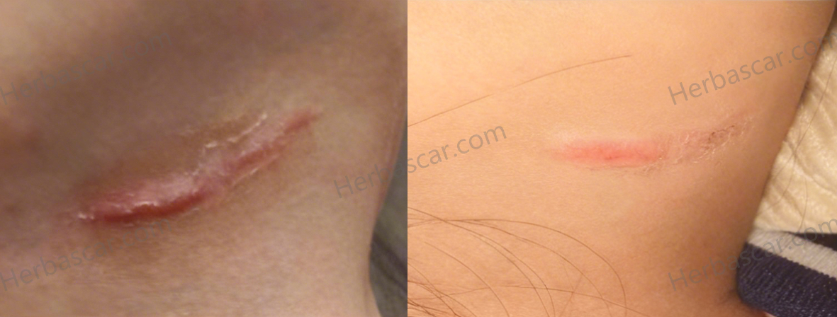 Cat Scratch Turned Into a Raised Scar? How a 6-Year-Old Girl Finally Flattened It Before It Became Permanent