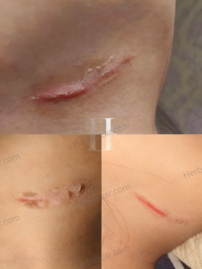 Before and after comparison of a neck hypertrophic scar