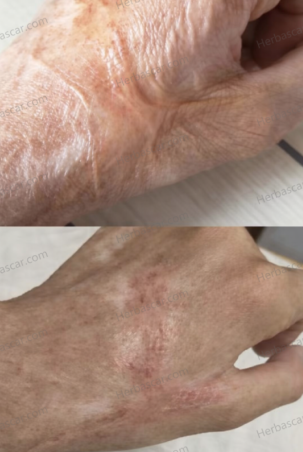 Before-and-after comparison of a burn scar on the back of the hand