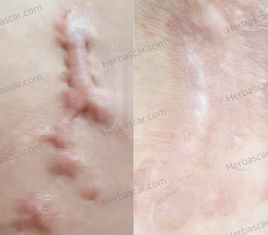 Treatment progress photos of secondary keloid scars.