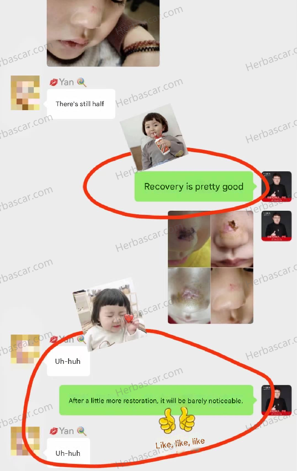 A 3-year-old child’s injury scar after a nose accident, and parent feedback following use of Herba Scar Care Solution.
