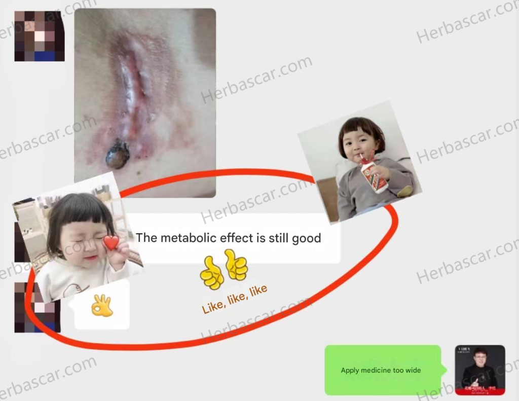 Real patient feedback after using Herba Scar Removal Solution.